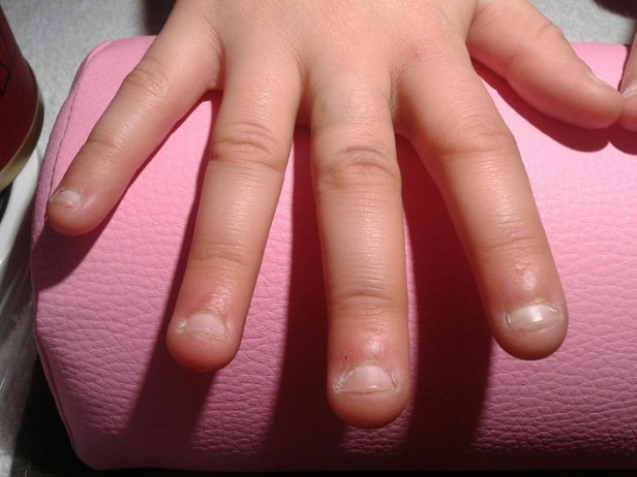 Diagnostika prstů prstů: okusované nehty