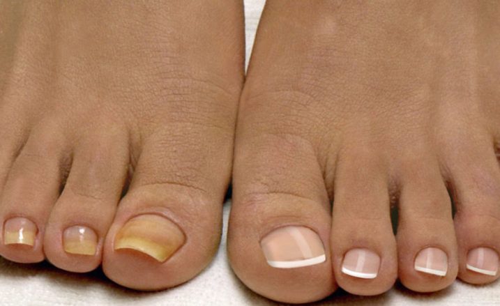 Diagnóza zdraví na díře, barva nehtů na nohou