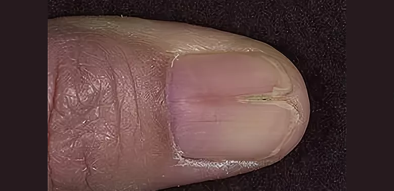 Tvar plochých nehtů na pažích a nohou na konci naznačuje infekci těla helminthickými invazemi