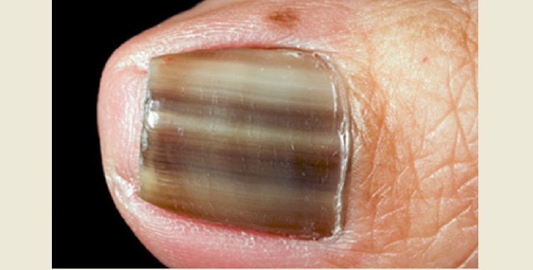 Diagnóza nemocí barvou nehtů v rukou dospělého a dítěte: hnědá