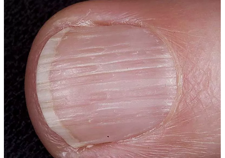 Diagnóza nehtů prstů a nohou: příčné a podélné pruhy a drážky, žebrované nehty