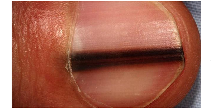 Diagnóza nehtů prstů a nohou: tmavé pruhy pod nehty