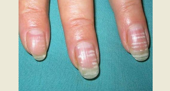 Diagnostika na nehtech prstů a nohou: bílé pruhy pod nehty