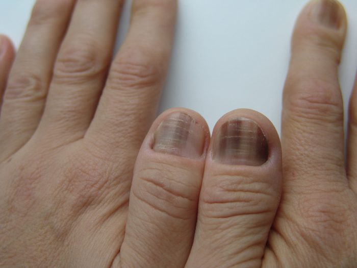 Diagnóza nemocí barvou nehtů v rukou dospělého a dítěte: červené