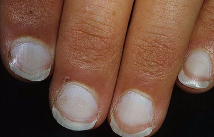 Diagnóza nemocí barvou nehtů v rukou dospělého a dítěte: bílá