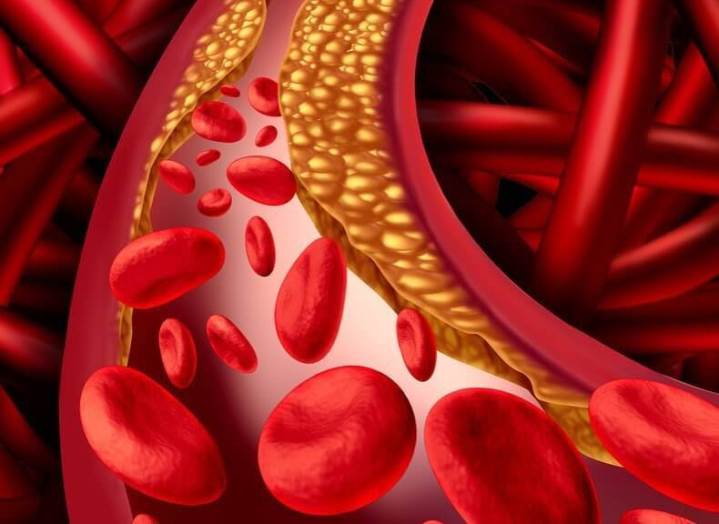 Zvýšený celkový cholesterol s normálním aterogenním indexem