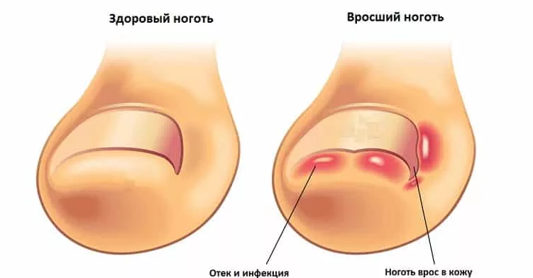 Постоянно врастает ноготь на большом пальце ноги и появляется гной