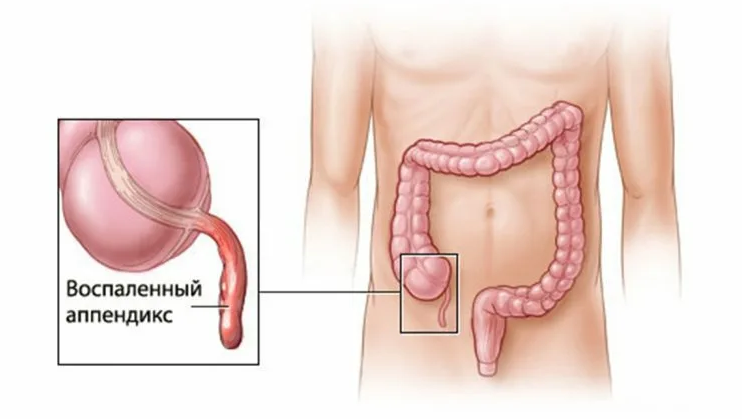Аппендицит у человека находится справа