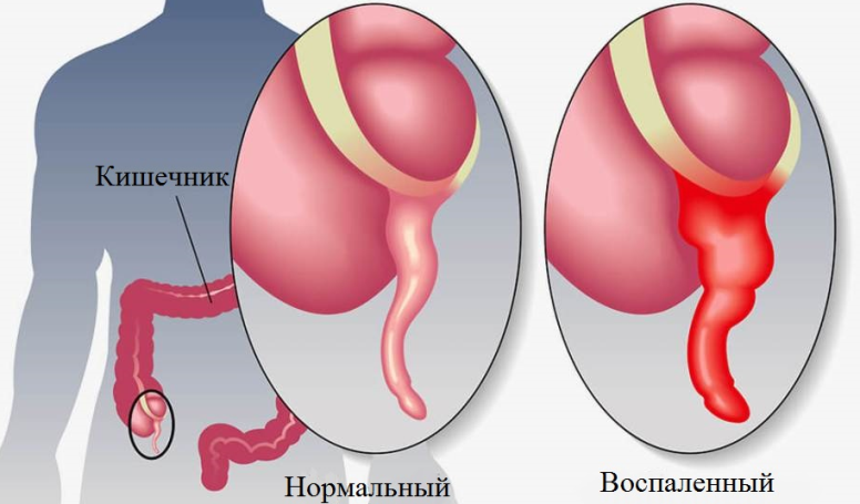 Apendisitis: Gejala