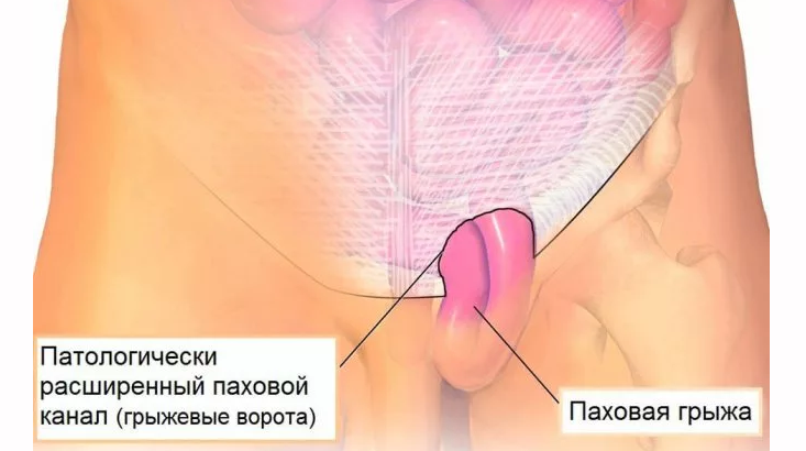 Грыжа около паха