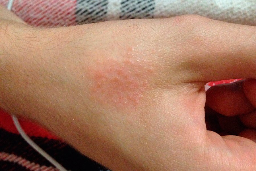 Je možné rozmazat dermatitidu, ekzém, s alergiemi na rozmazání jódu?