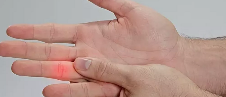 Fraktura prstu na paži: Co dělat?