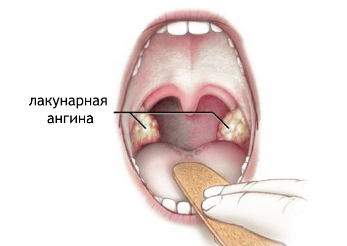 Lacunar Tonsillitis