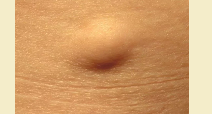 Zhirovik, Lipoma