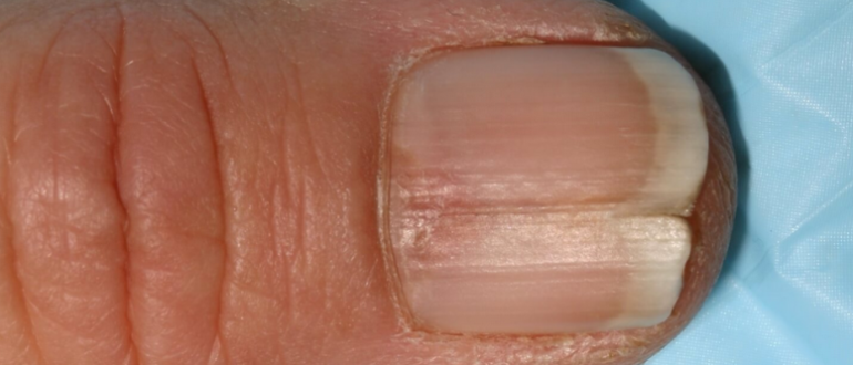 En spricka på nageln på handen: Vad ska jag göra?