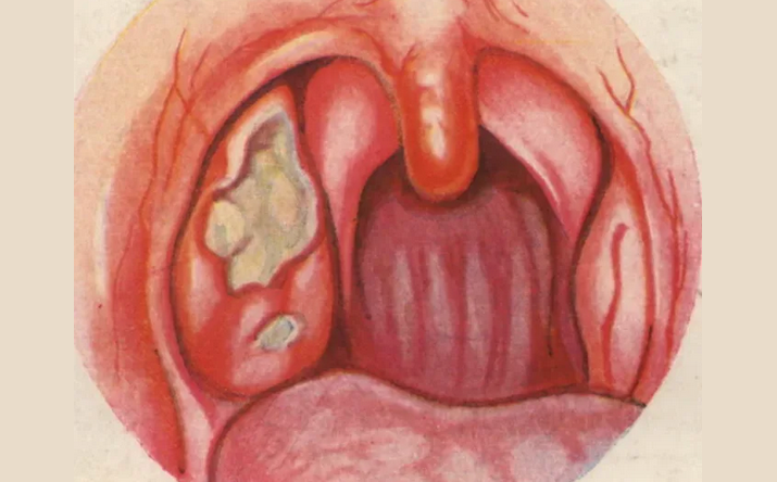 Ulcerativní tonzilitida