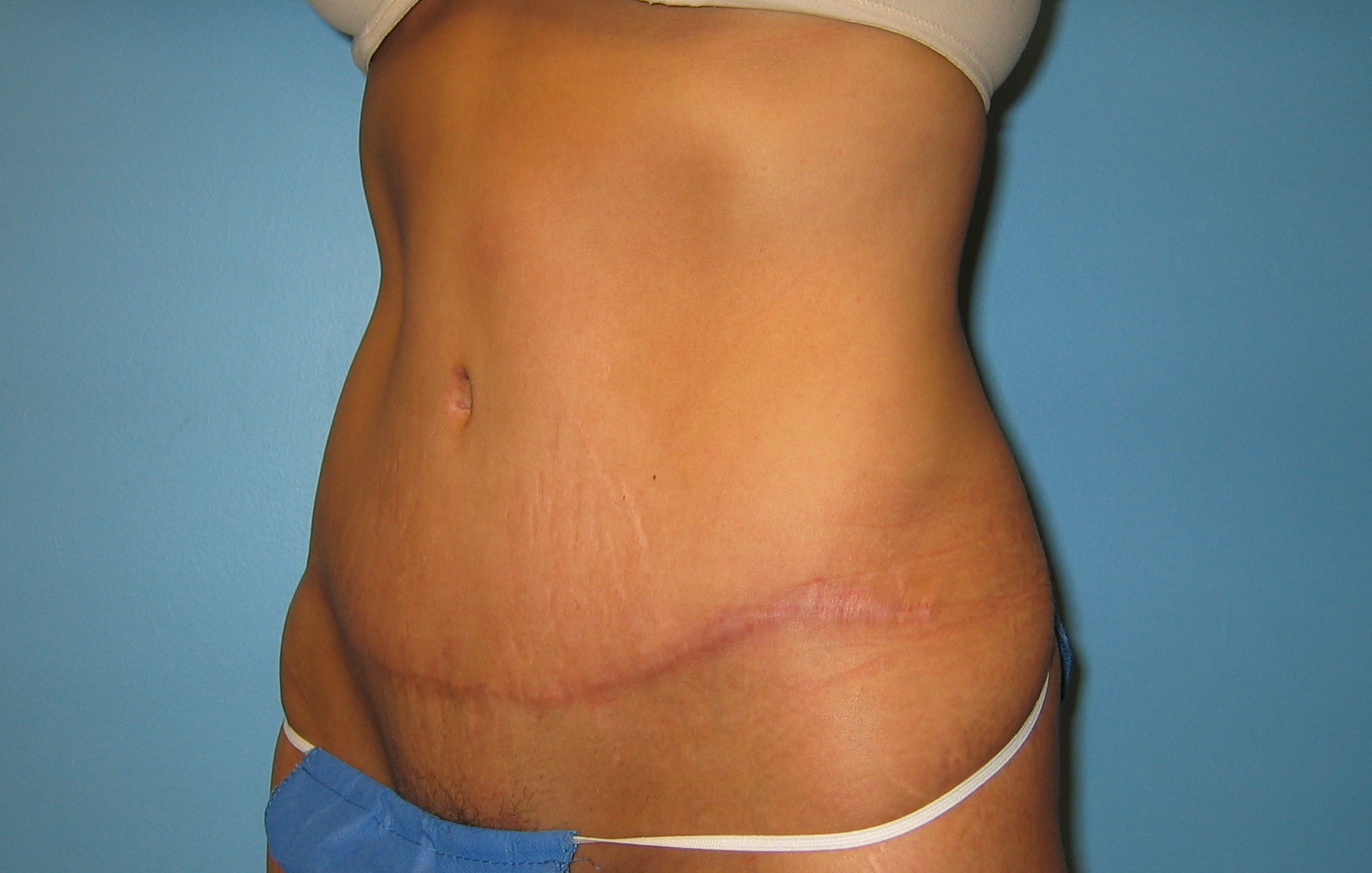 Abdominoplastika