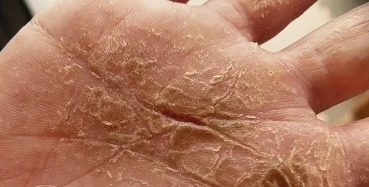 Kůže na dlaních silně praskne