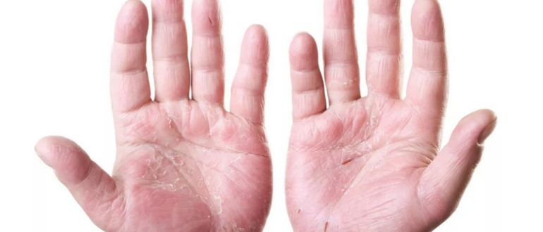 Kůže na dlaních se peeling a praskání: co dělat, co léčit?
