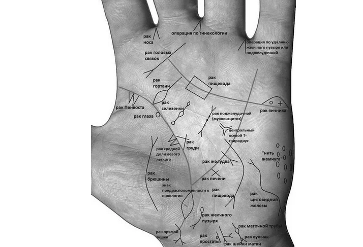 Атлас болезней на ладони руки, в том числе и на линии жизни